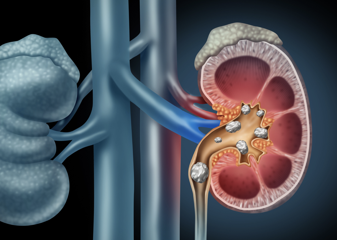kidney stones 2.png kidney stones 2.png