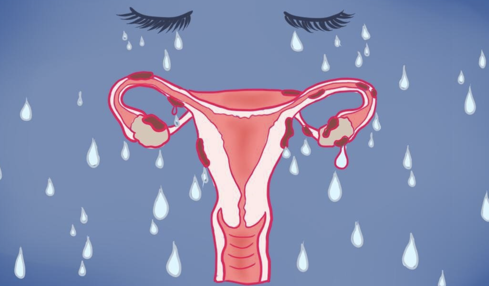 endometriosis.png endometriosis.png