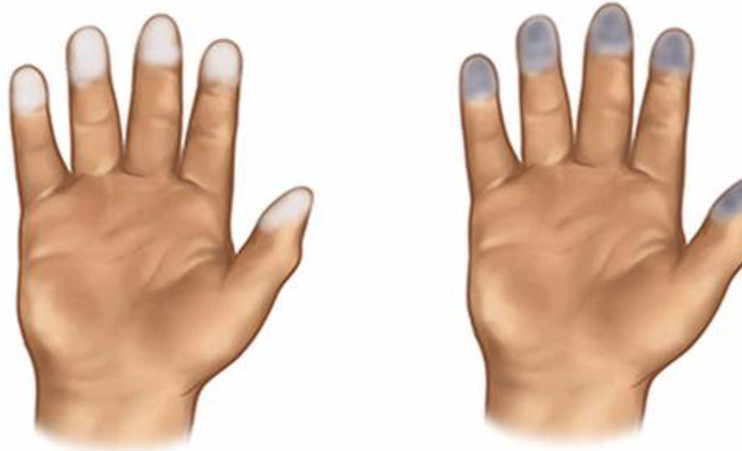raynaud.png raynaud.png