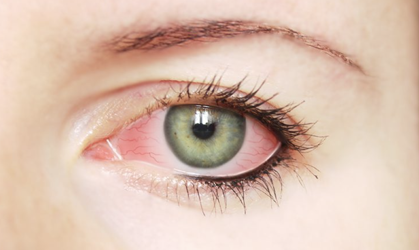 conjunctivitis.png conjunctivitis.png